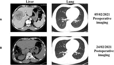 Regorafenib combined with sintilimab as second-line treatment for advanced HCC patient: a case report